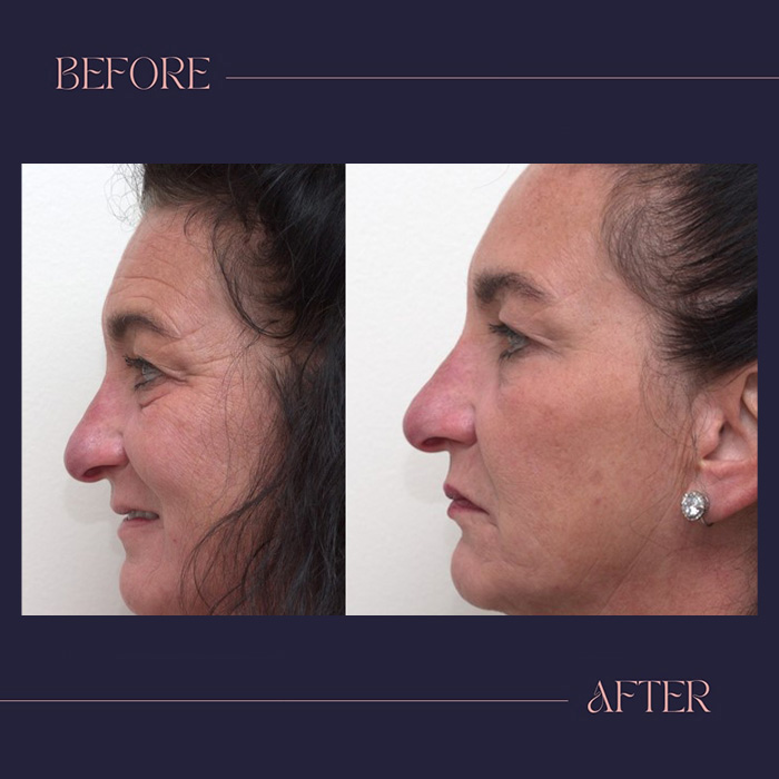 The image shows a person s face with two different stages of makeup application, labeled  before  and  after,  highlighting the results of cosmetic enhancement.