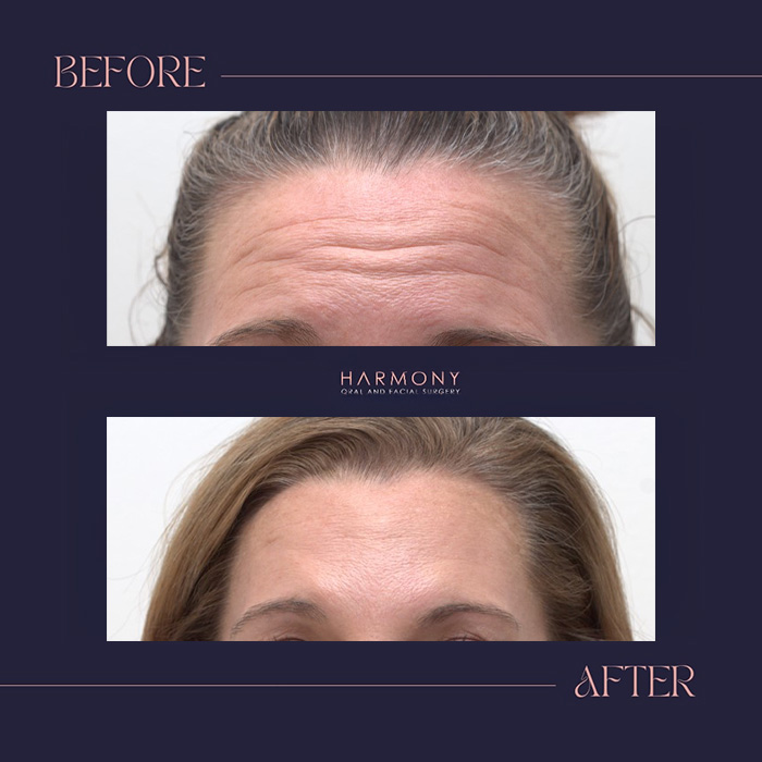 The image shows a before-and-after comparison of a person s face with visible signs of aging, likely related to skin care treatments or cosmetic procedures.
