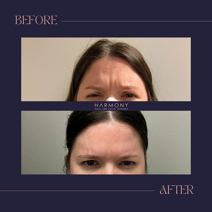 The image shows a split-screen comparison of a person s face before and after a cosmetic procedure, with text indicating  HARMONY  between the two images, suggesting a transformation or improvement in appearance.