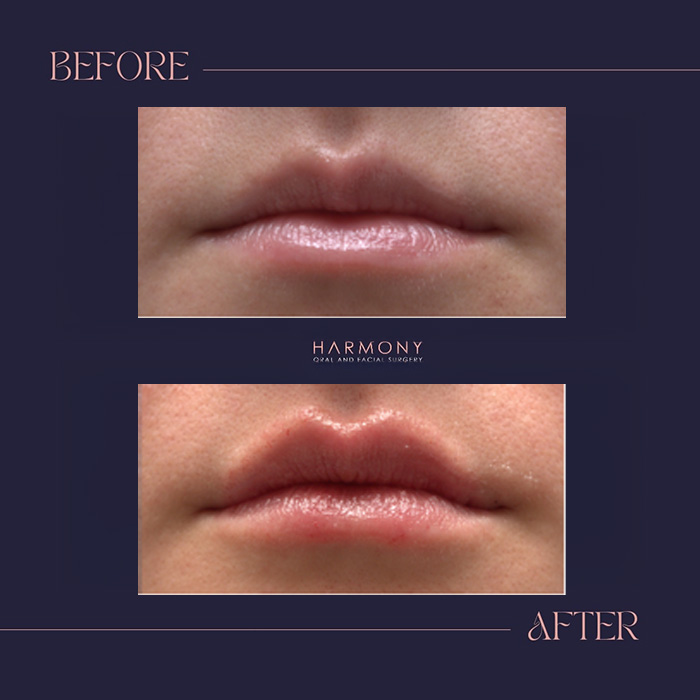 The image shows two close-up photographs of lips with lipstick applied on a person s face, before and after a cosmetic treatment.