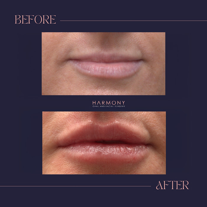 The image shows a before-and-after comparison of cosmetic treatments on a person s lips, with the before picture showing the natural state and the after picture showing the results of lip enhancement.