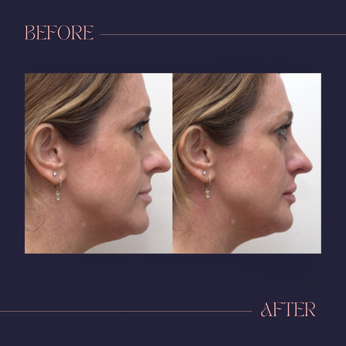 The image shows a side-by-side comparison of a person s face before and after cosmetic treatment, highlighting the results of nose reshaping surgery.