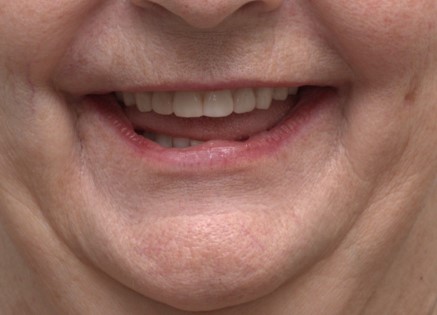 The image shows a close-up of a person s face with a wide smile, revealing teeth, set against a background that appears to be a plain wall.