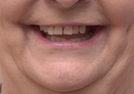 The image shows a close-up of a person s face with a wide smile, revealing teeth and a dimple on one cheek, against a blurred background that appears to be indoors.