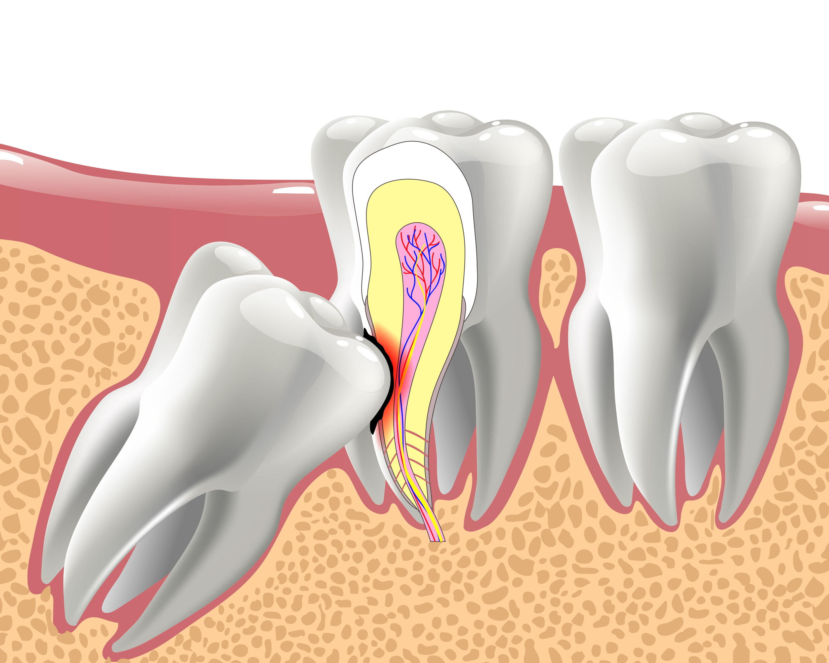 The image is a medical illustration depicting an open mouth with teeth, gums, and a tongue, showing an internal view of a tooth with roots and pulp chamber, alongside a cross-sectional view of a jawbone and teeth in the oral cavity.